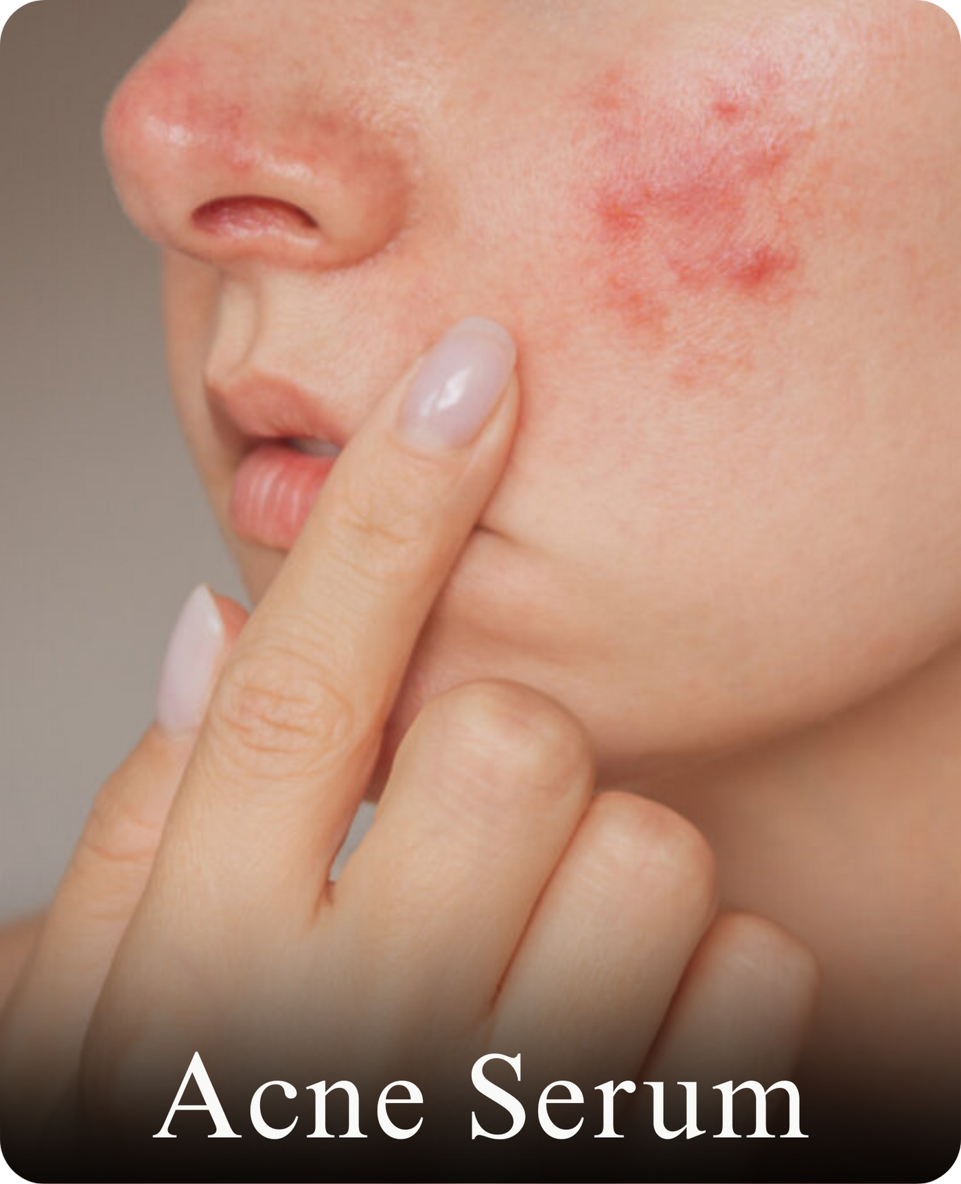 Acne Serum