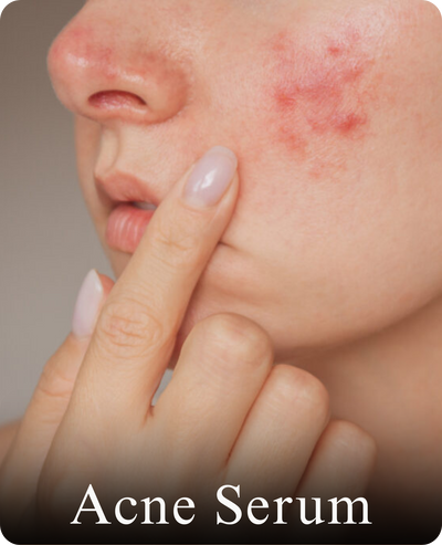 Acne Serum